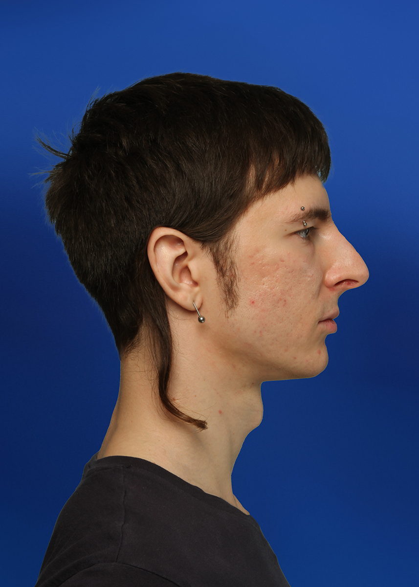 After Rhinoplasty - Front View